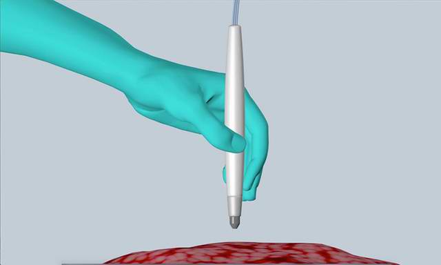 96% accurate tumour detection only in 10 seconds with MasSpec Pen