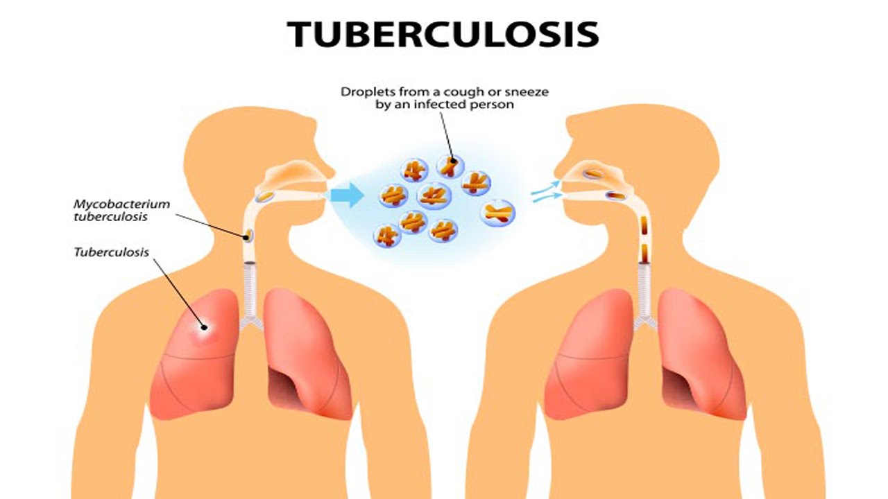 A Glimpse of the new global commitment to end tuberculosis